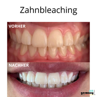 zahnbleaching 2
